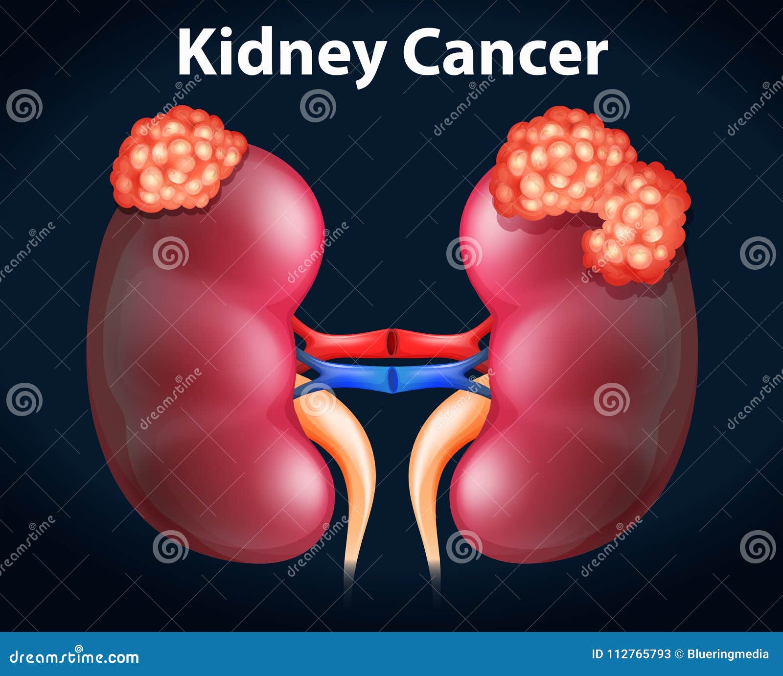 Diagramma Che Mostra Il Cancro Del Rene Illustrazione Vettoriale Illustrazione di formazione