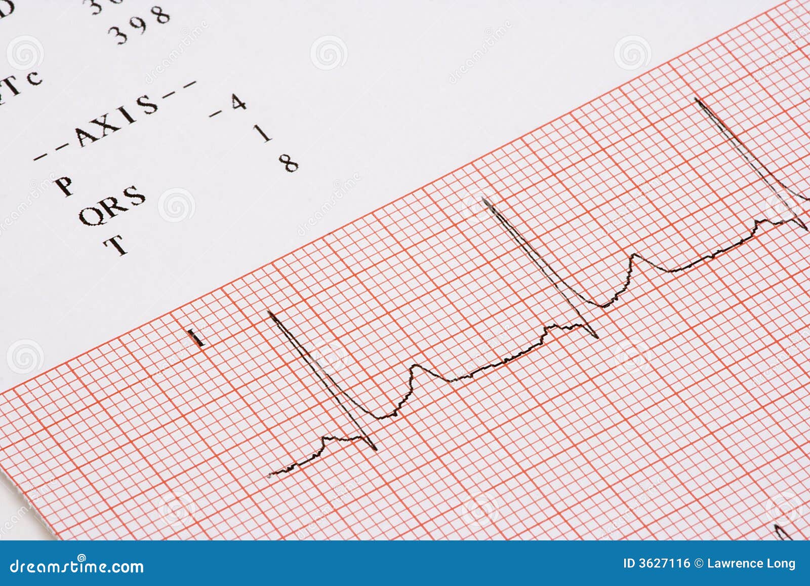 Diagramma di EKG. Un primo piano di un grafico che mostra un tabulato di EKG.