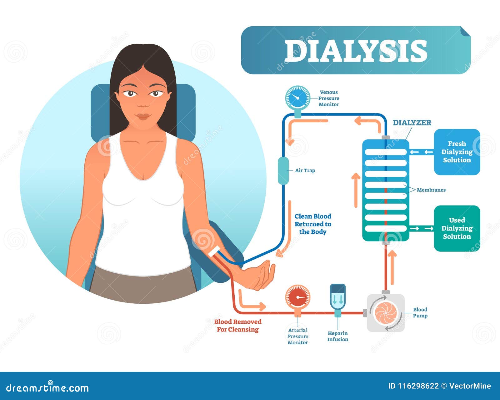 dialysis medical procedure system   diagram. filtering blood in case of kidney malfunction.