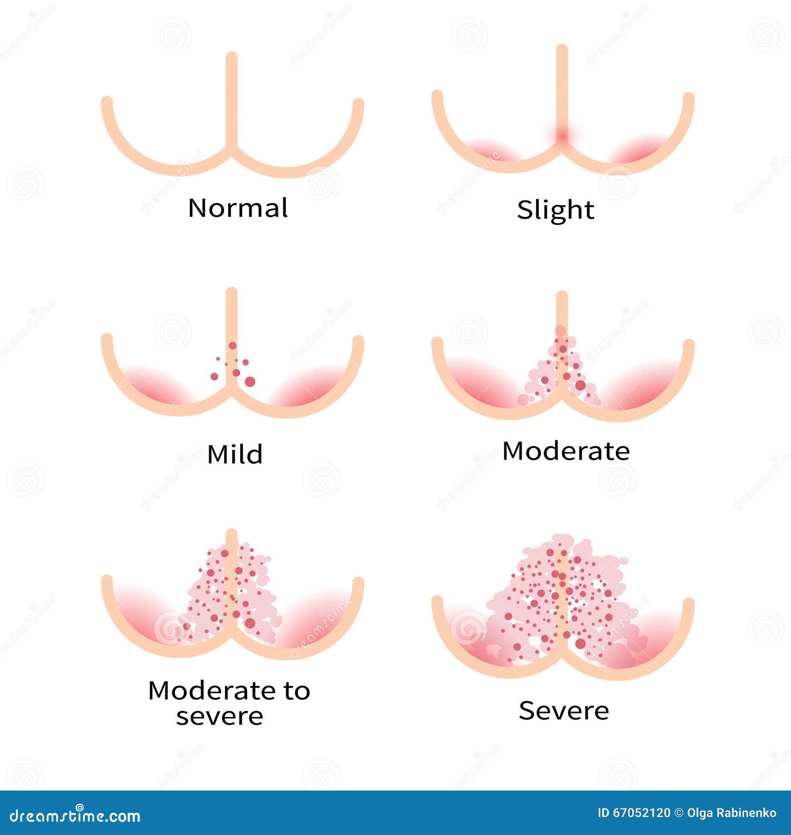 diaper rash types