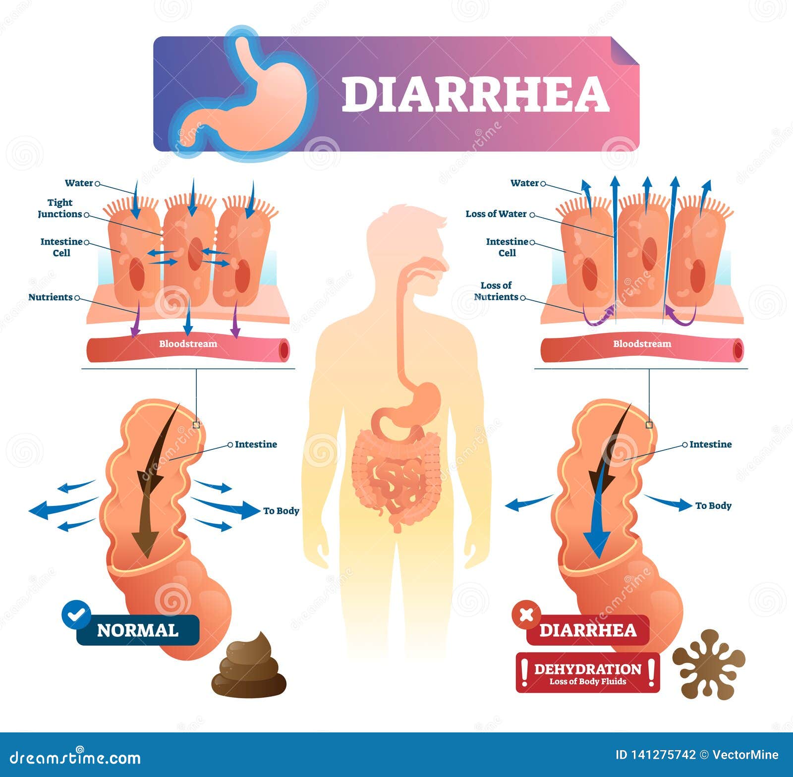 diarrhea  . labeled stomach gut illness medical scheme.