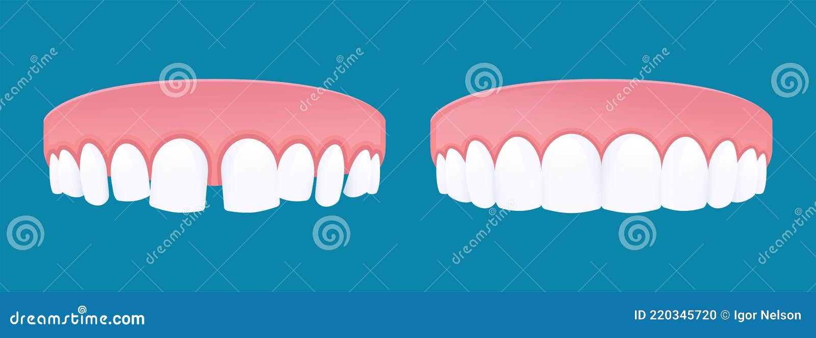 Diastema Teeth with Dental Spacing and Healthy Teeth. Vector Cartoon Style Stock Vector - Illustration of teeth, askew: 220345720 Diastema Teeth with Dental Spacing and Healthy Teeth. Vector Cartoon Style Stock Vector - Illustration of teeth, askew: 220345720