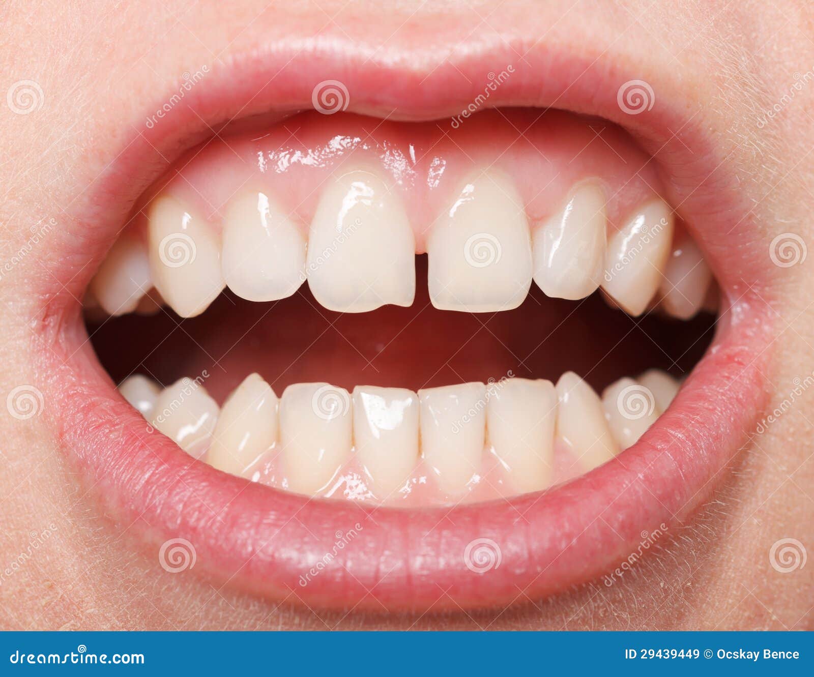 Diastema between the Upper Incisors Stock Image Image of health
