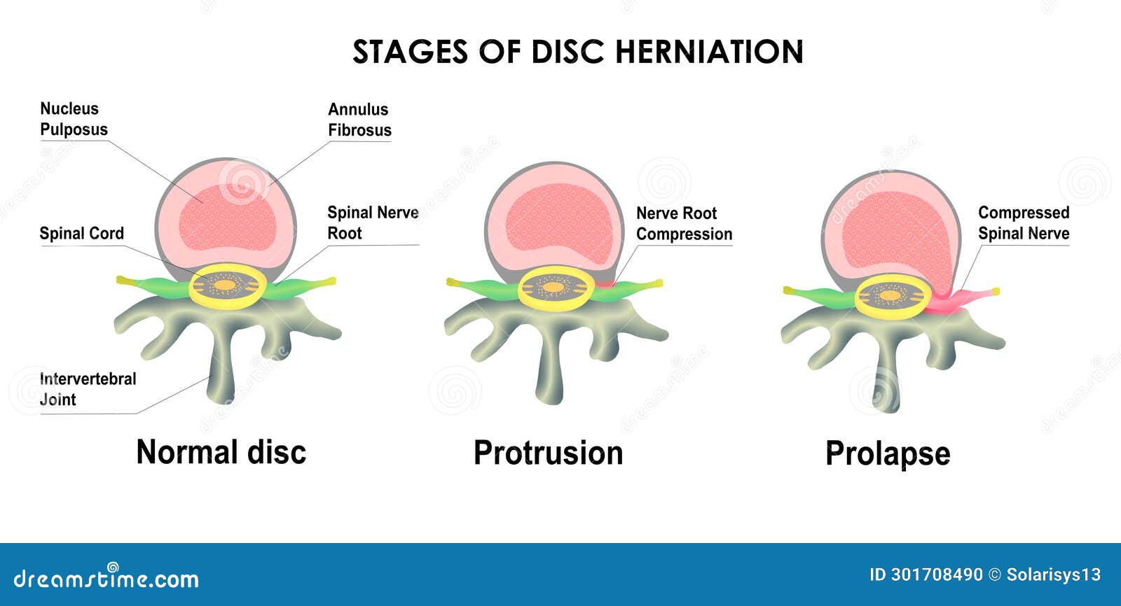 Difference between Bulging Disc and Herniated Disc. Stages of Spinal