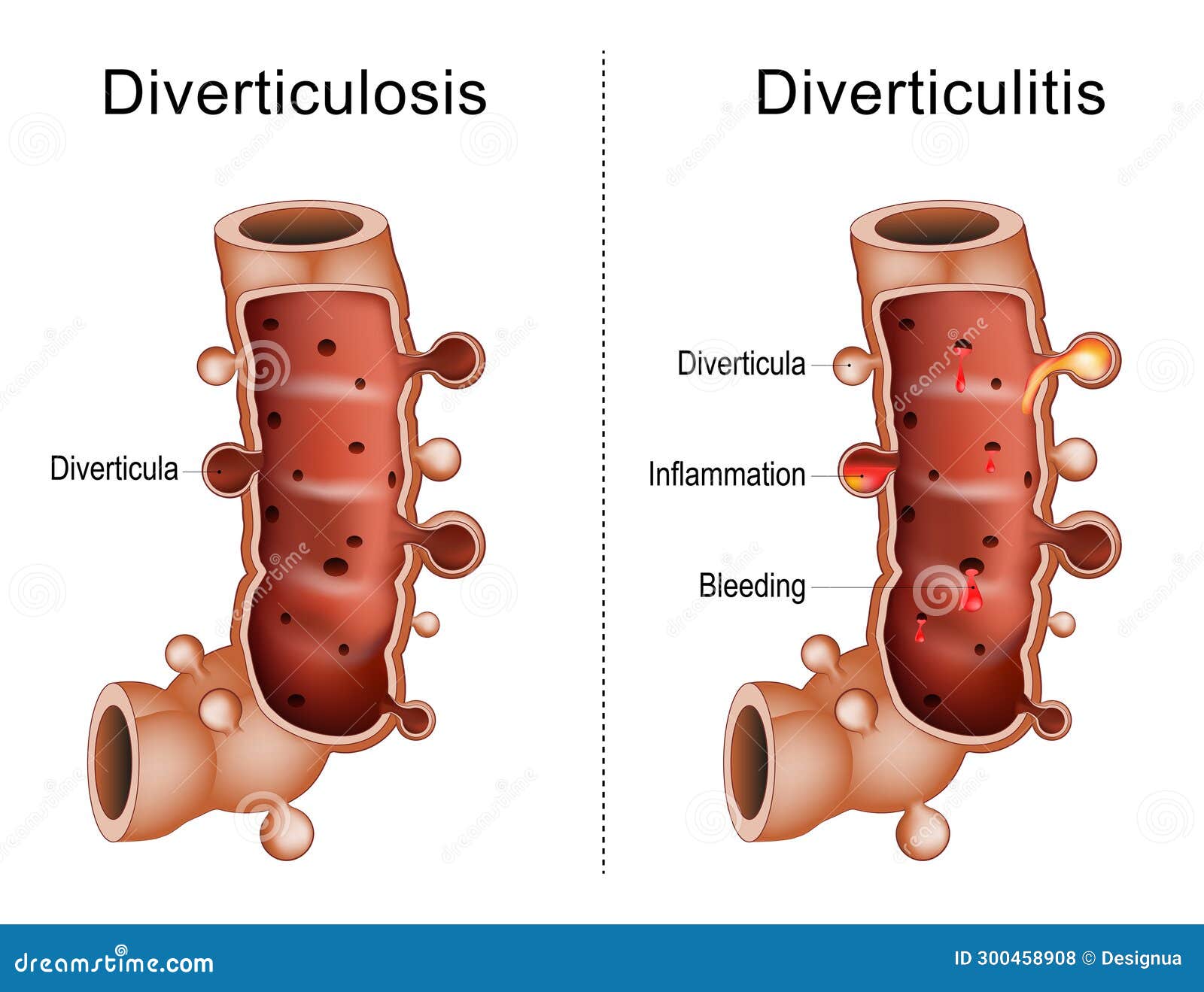 Difference Between Diverticulitis And Diverticulosis Vector difference-between-diverticulitis-and-diverticulosis-vector