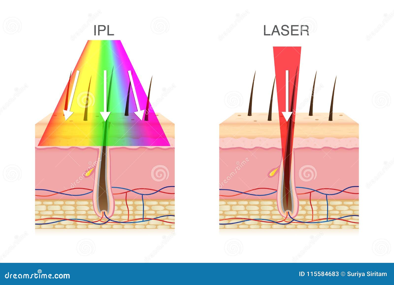 the difference of using ipl light and laser in hair removal.