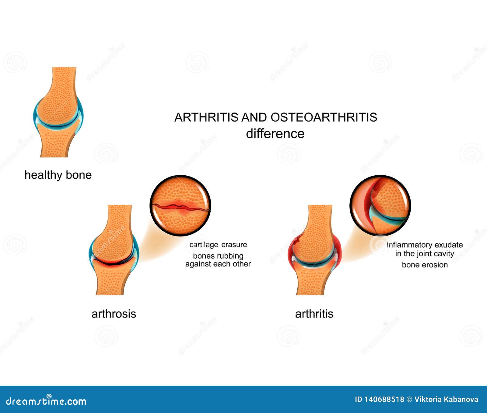 arthrosis arthrosis