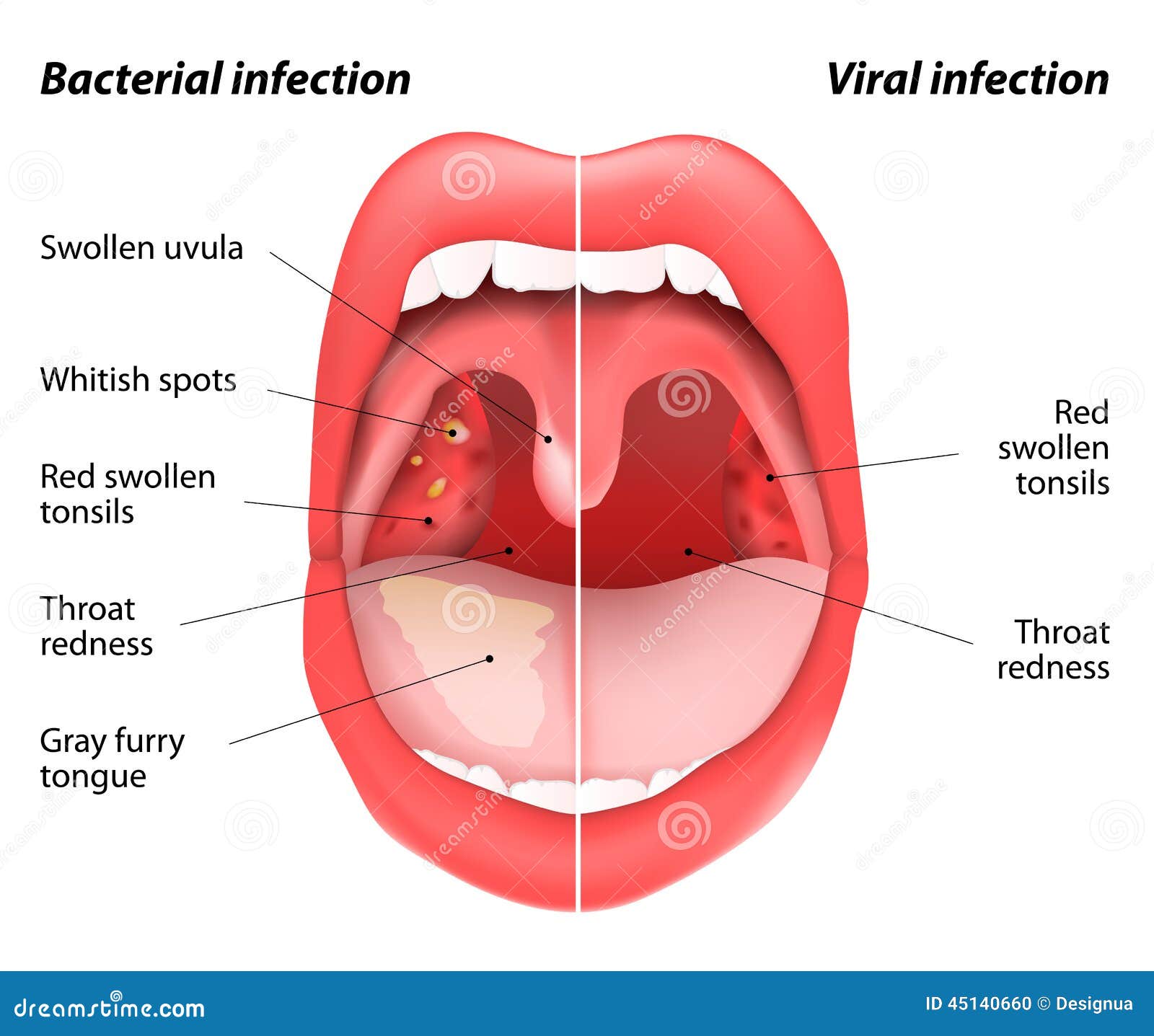 the differences between viral and bacterial infections