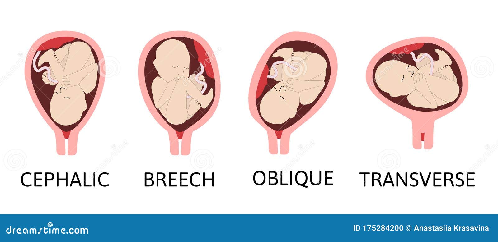 cephalic presentation oblique lie