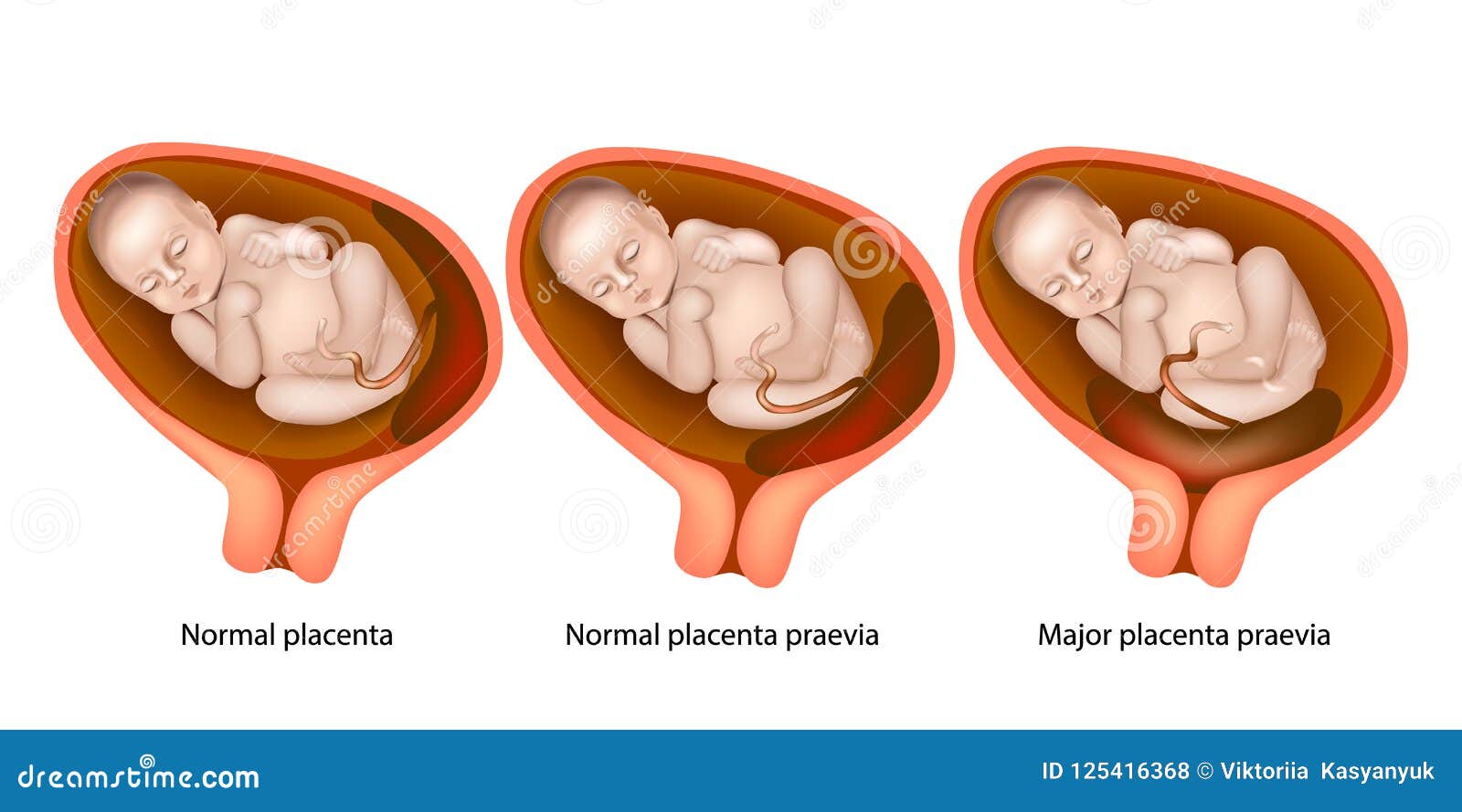 different placental locations during pregnancy