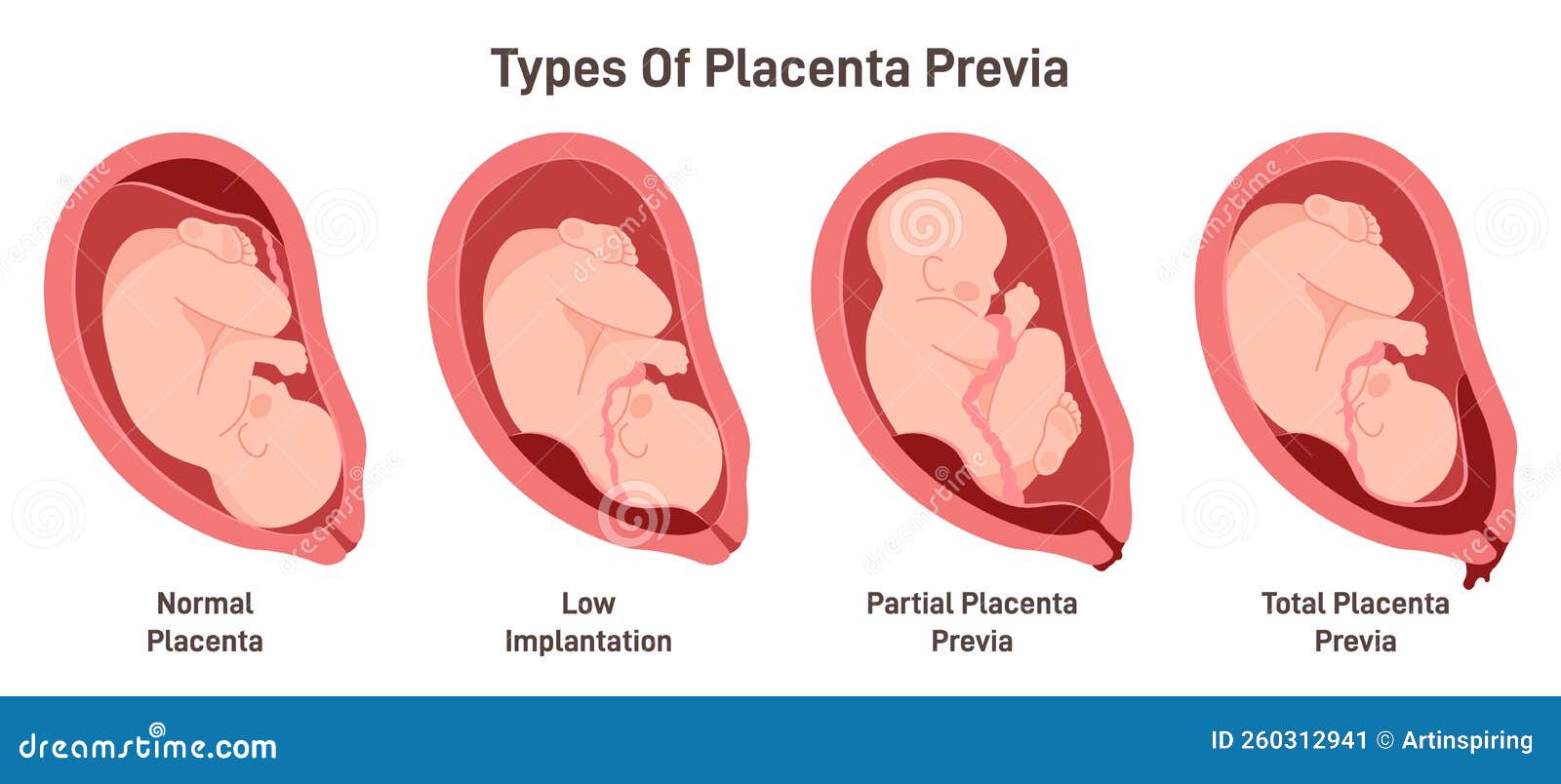 different types of placental presentation