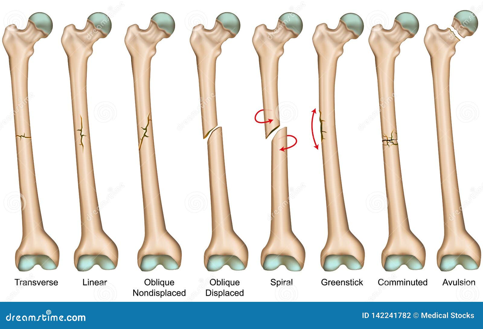 Types Of Fracture Fracture Bone Set Infographics Vect - vrogue.co