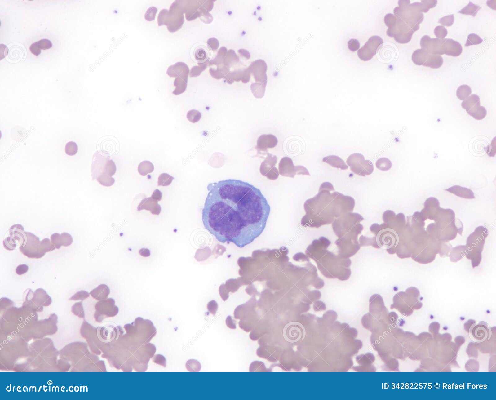 diffuse large b cell lymphoma, peripheral blood.