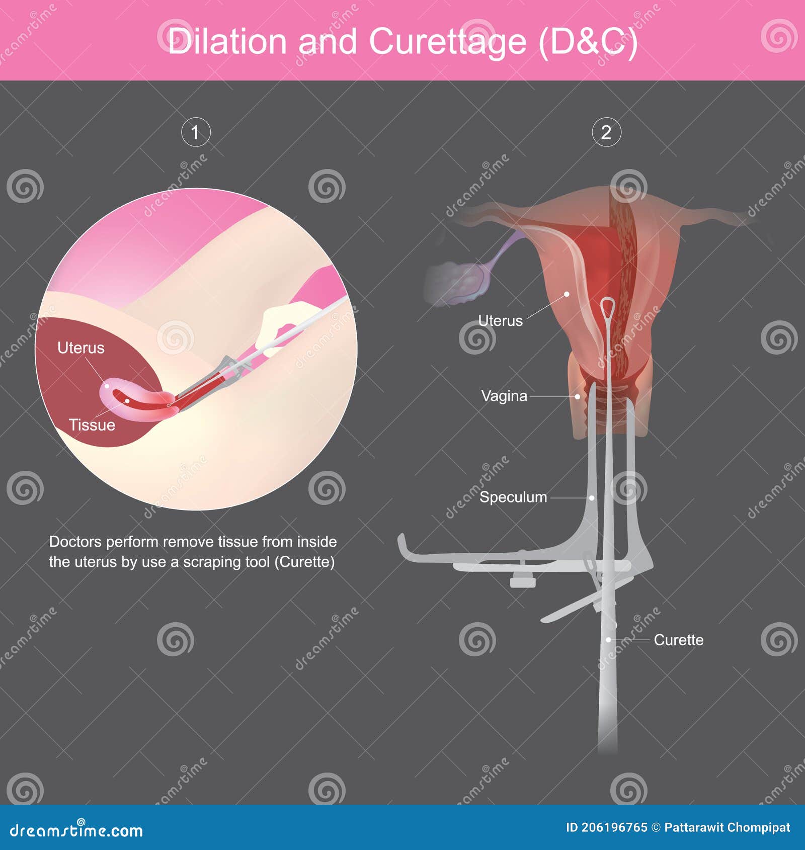 dilation and curettage.