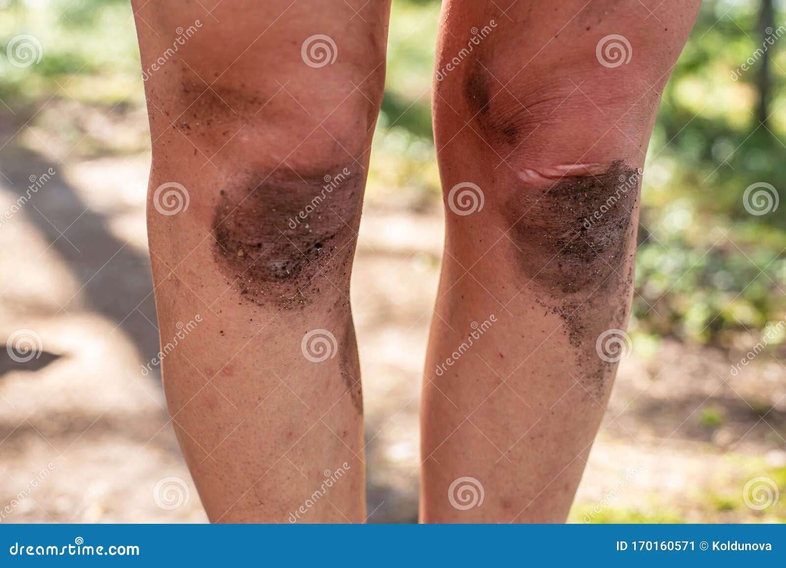 dirty-knees-adult-woman-close-up-camp-blurred-background-dirty-knees-adult-woman-close-up-camp-170160571.jpg