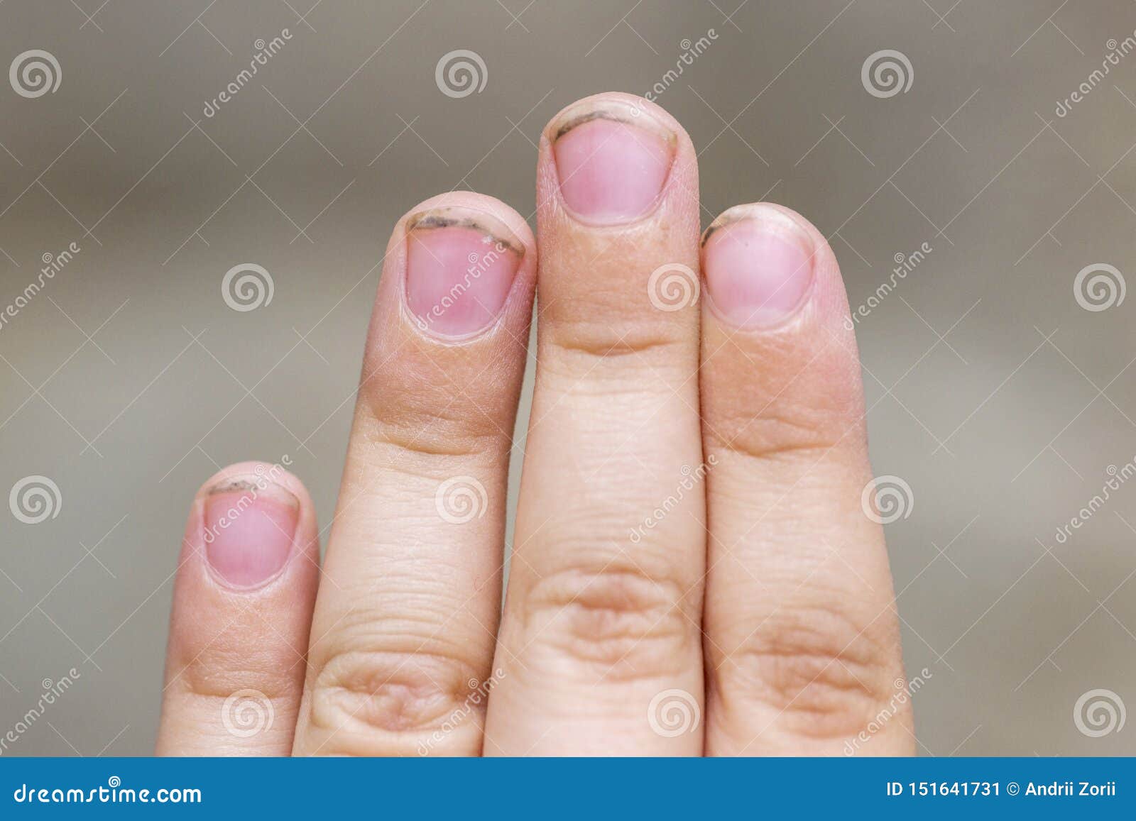 Dirty Long Nails Have Germs Make Sick. Dirt Under the Nails of a Child  Stock Image - Image of cure, fingernail: 151641731