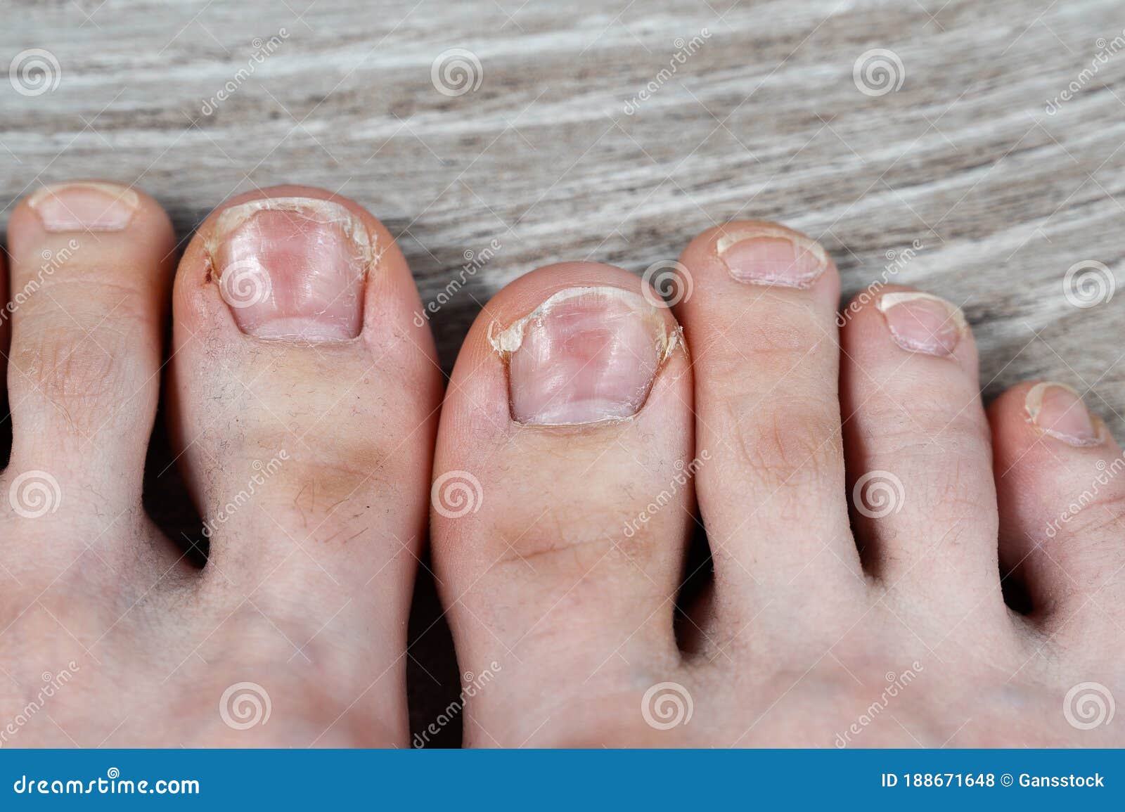 Dirty Toes with Hair and Ingrown Cracked Nails Stock Photo - Image of broken, health: 188671648 Dirty Toes with Hair and Ingrown Cracked Nails Stock Photo - Image of broken, health: 188671648