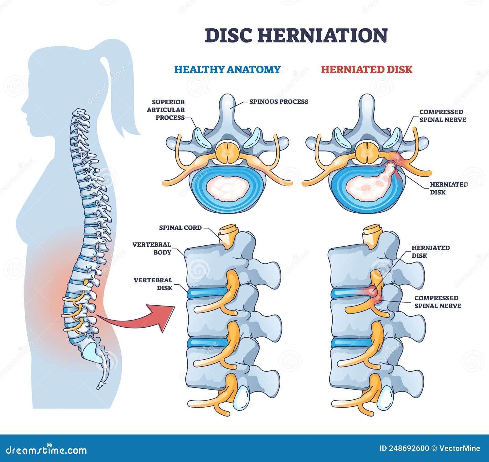 disc herniation or spine nerve compression vs healthy anatomy outline diagram