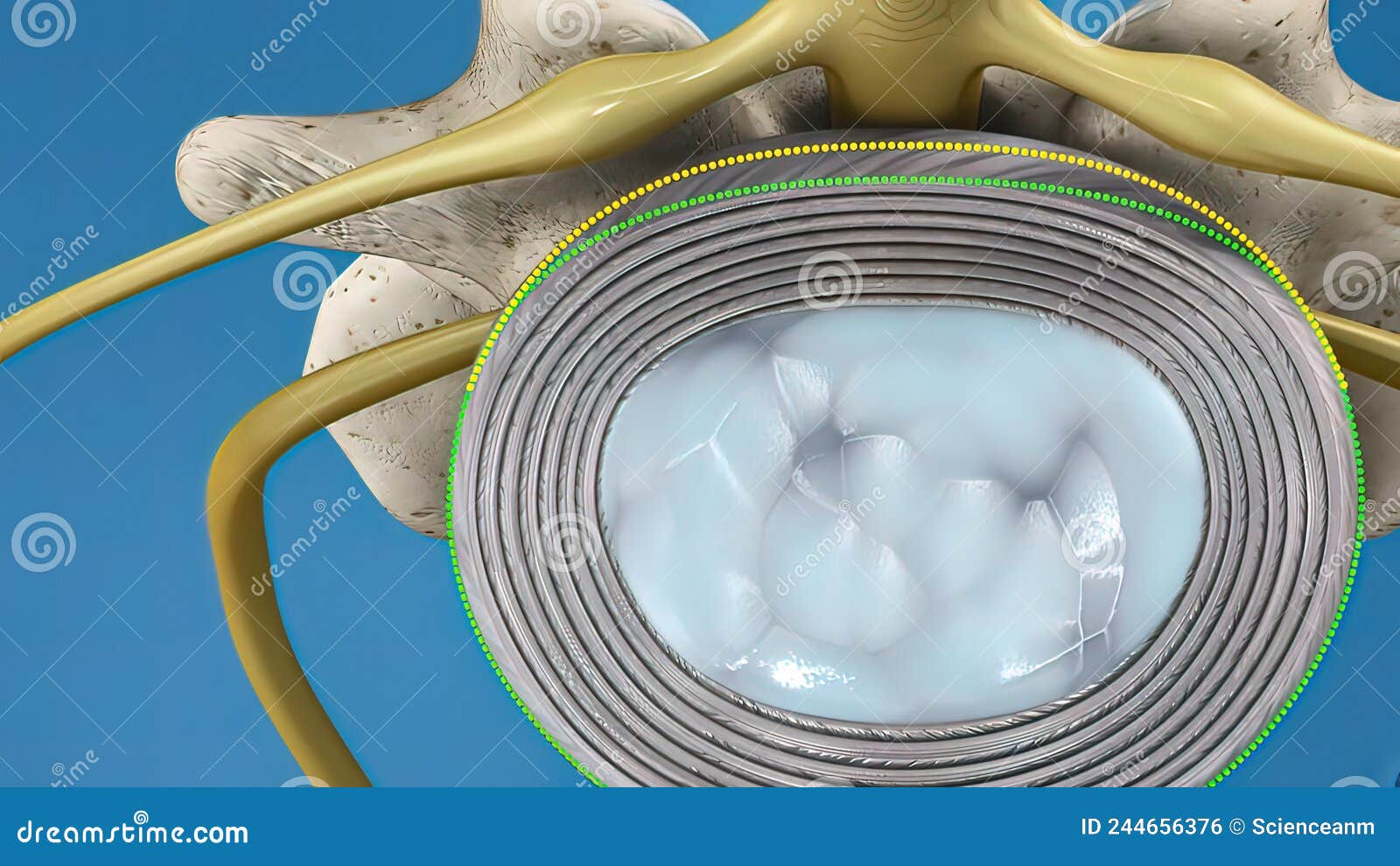 Disc System Slippage and Nerve Pressure Stock Illustration