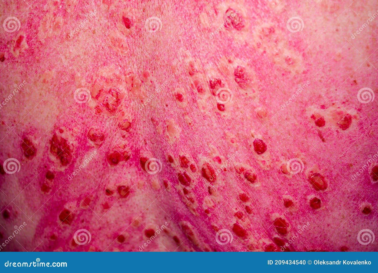 Discoid Rash Of System Lupus Eruthematosus Stock Photo Image Of