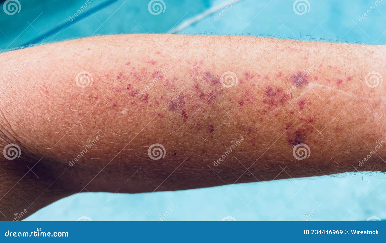 discolored spots of senile purpura, aging skin