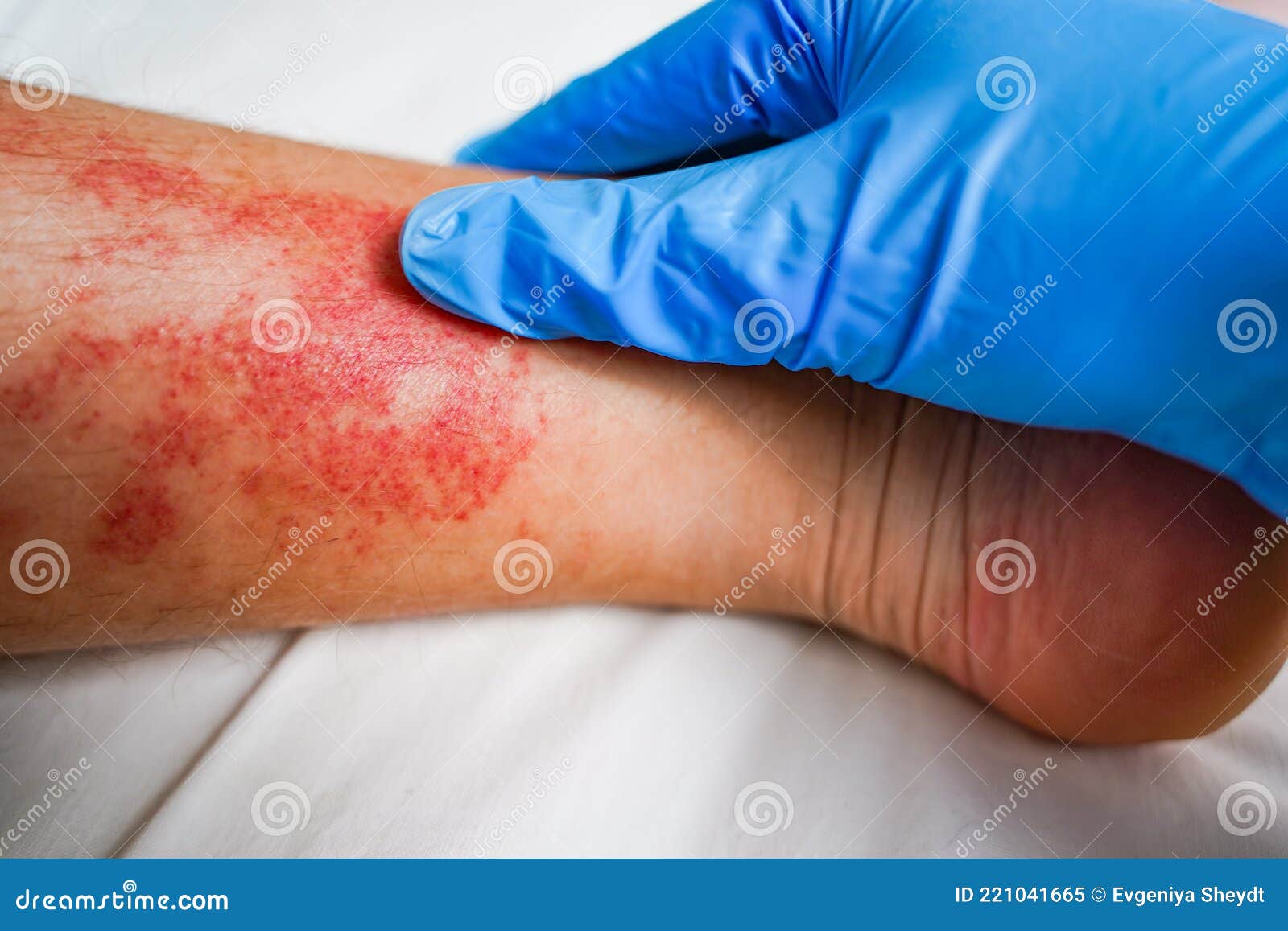 Disease Of The Skin On The Legs Itchy Red Rashes And Spots Stock Image