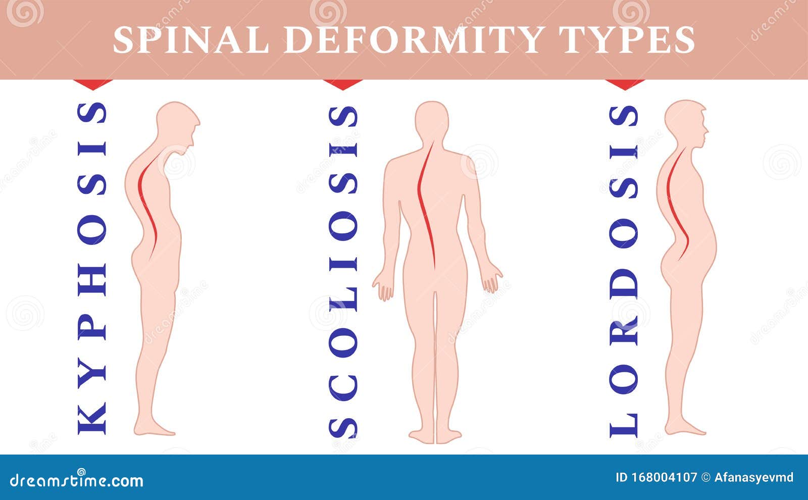 Diseases Of The Spine Scoliosis Lordosis Kyphosis Body Posture diseases-of-the-spine-scoliosis-lordosis-kyphosis-body-posture