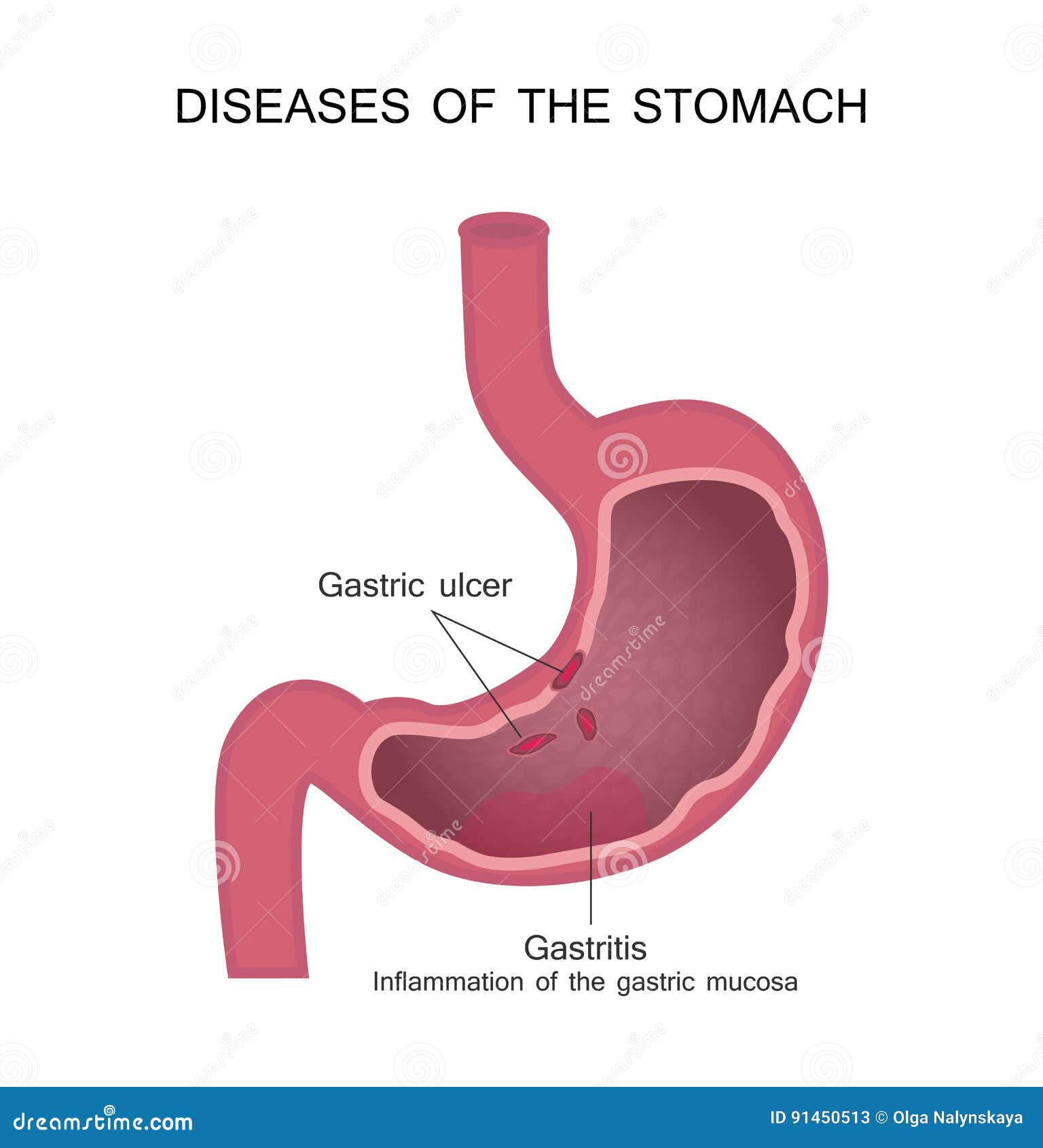 diseases of the stomach. peptic ulcer and gastritis.