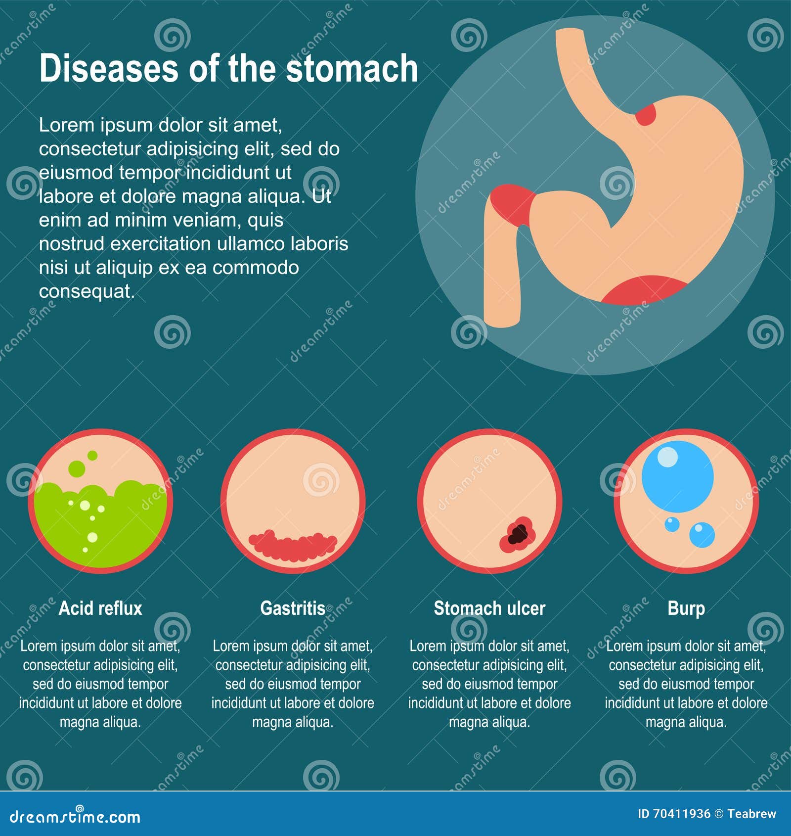 Diseases Of The Stomach. Vector Illustration Stock Vector ...