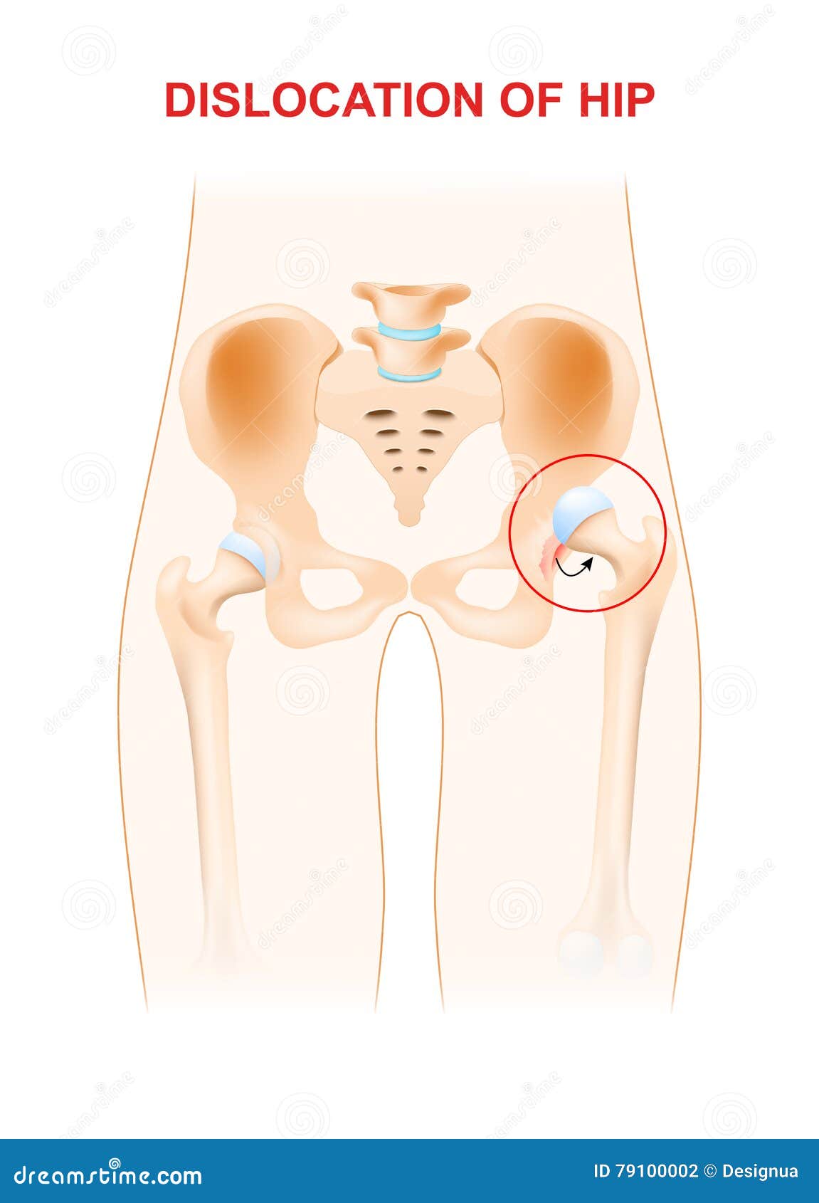 dislocation of hip