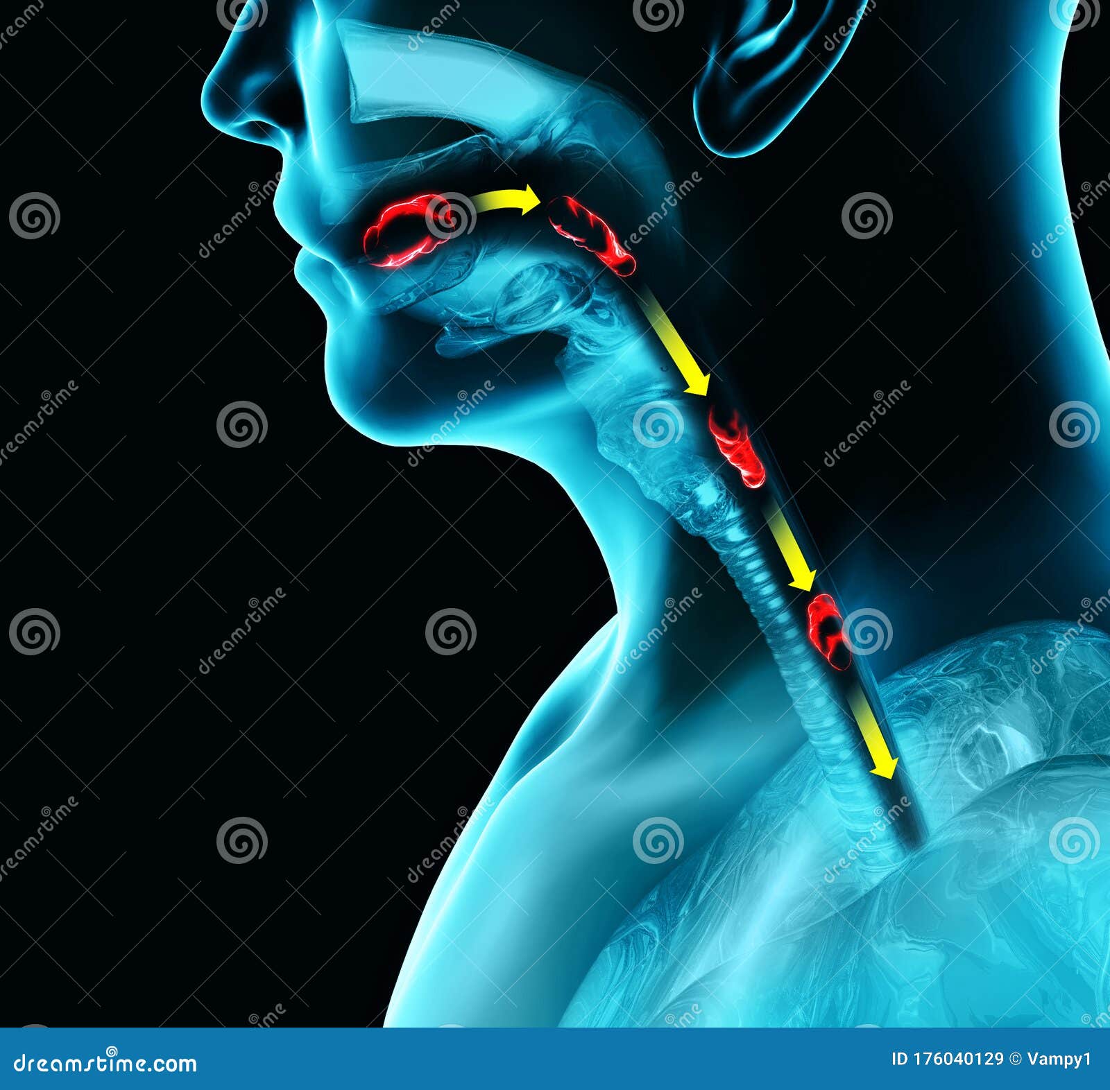 Dysphagia Cartoons Illustrations Vector Stock Images 408 Pictures dysphagia-cartoons-illustrations-vector-stock-images-408-pictures