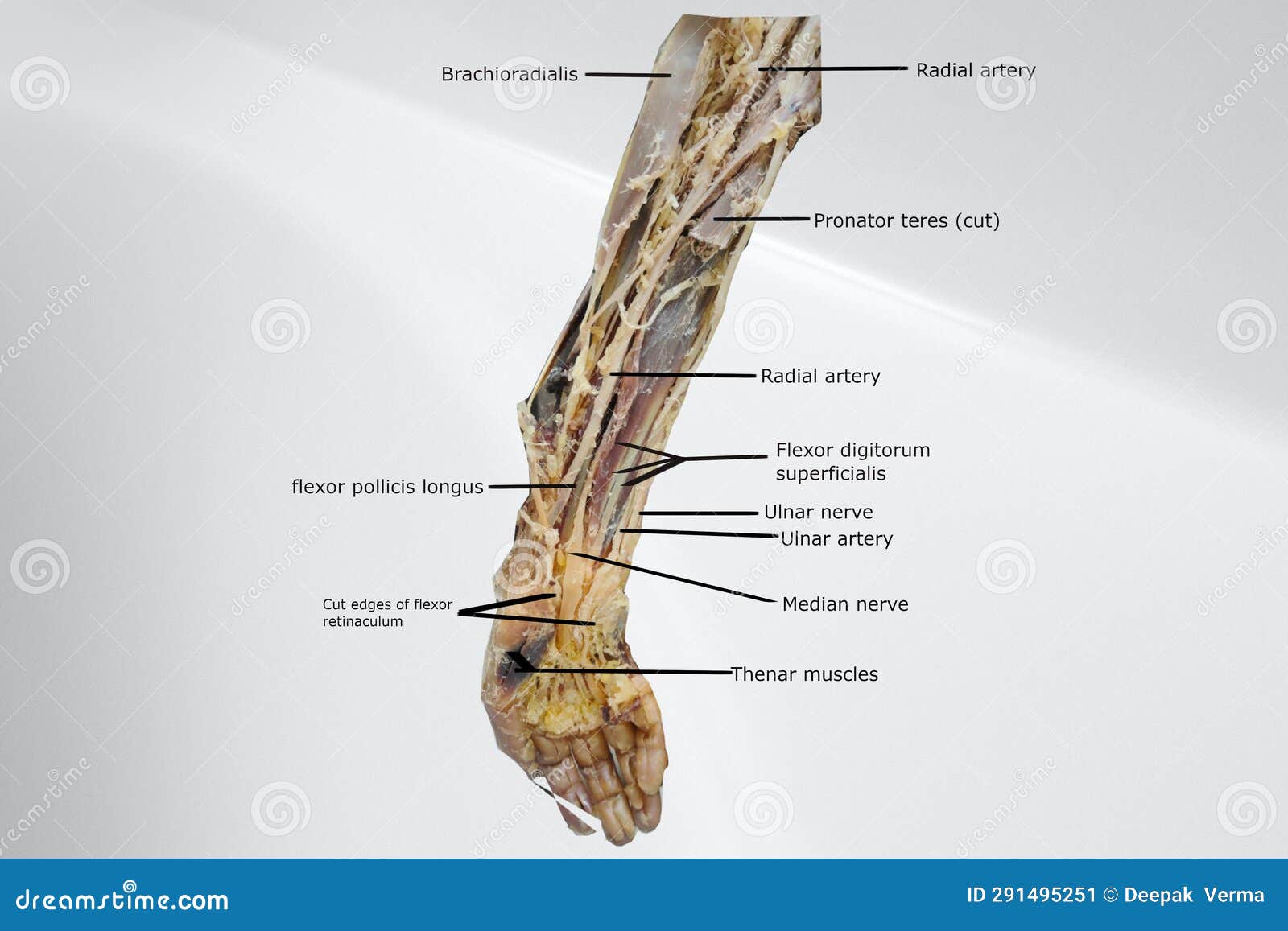 dissection picture showing the anatomy of front of the forearm and palmer side of hand