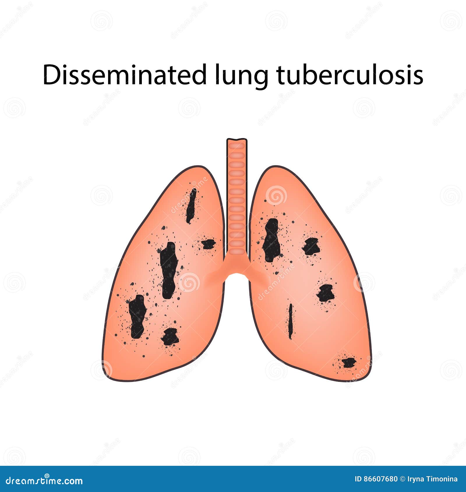 Disseminated Tuberculosis. Vector Illustration on Isolated Background