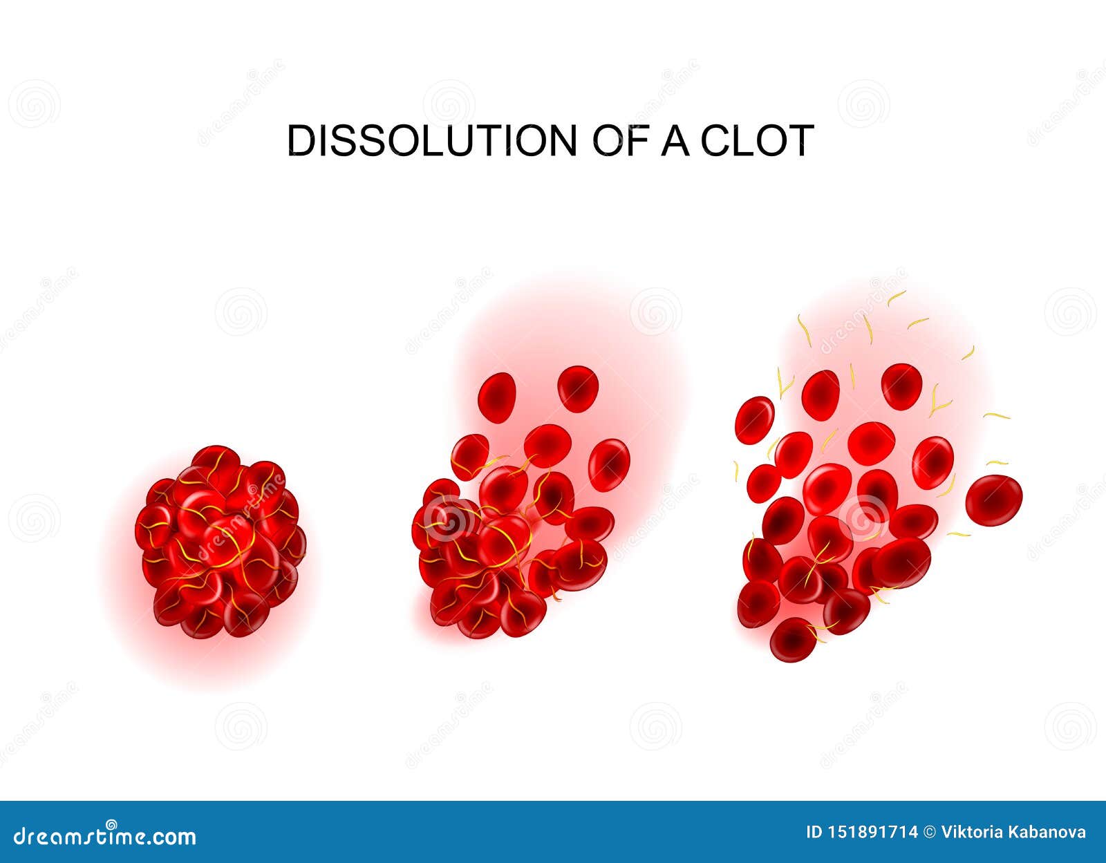 dissolution of the clot. thrombolysis