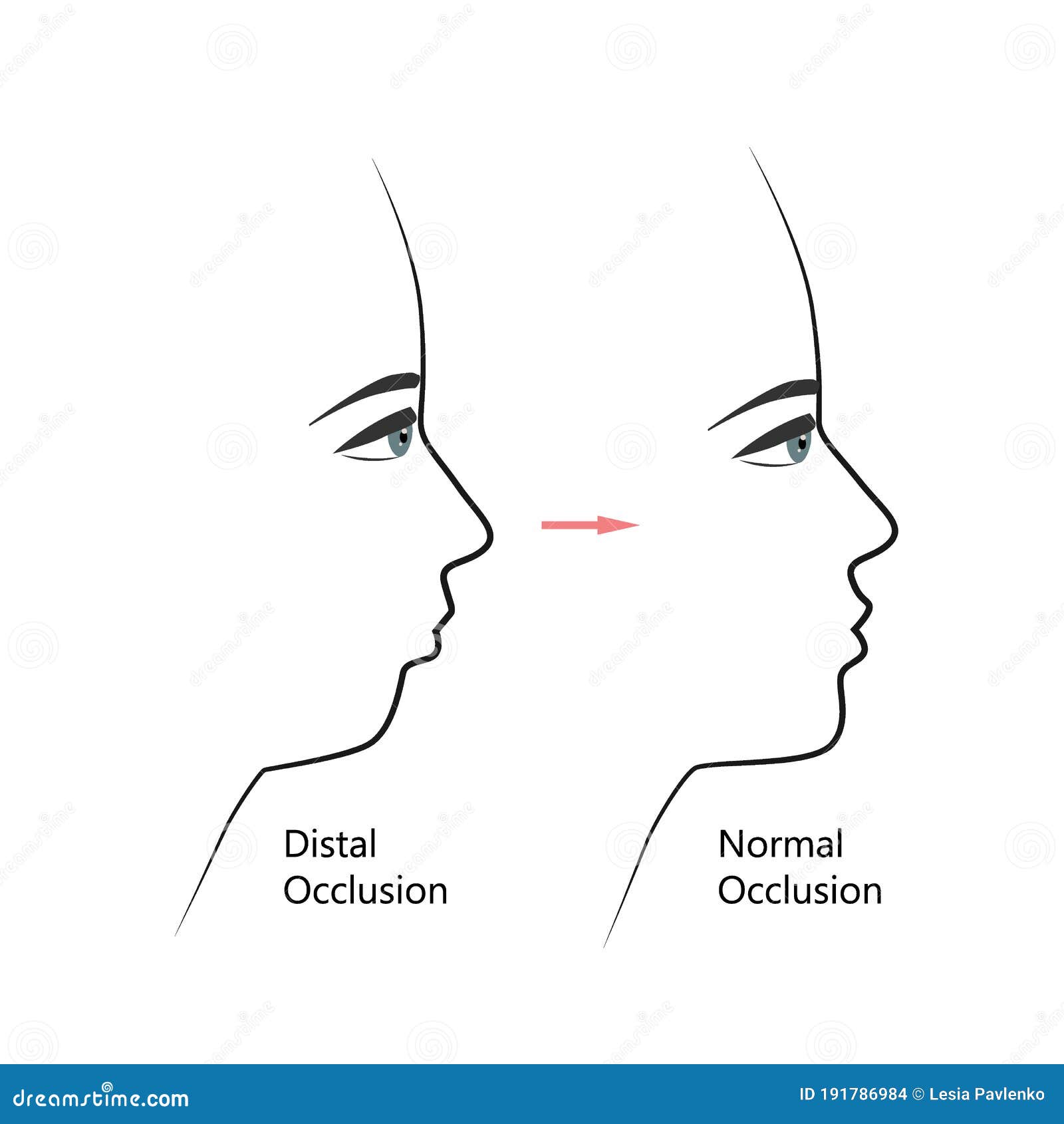 distal bite profile before and after orthodontic treatment. human with malocclusion, lower jaw pushing back, bite