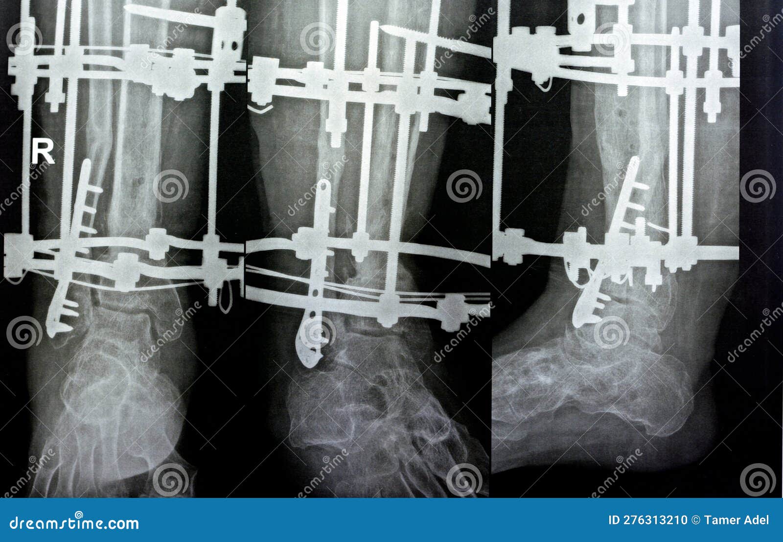 Leg In Ilizarov External Fixator, Ilizarov Apparatus Stock Photography