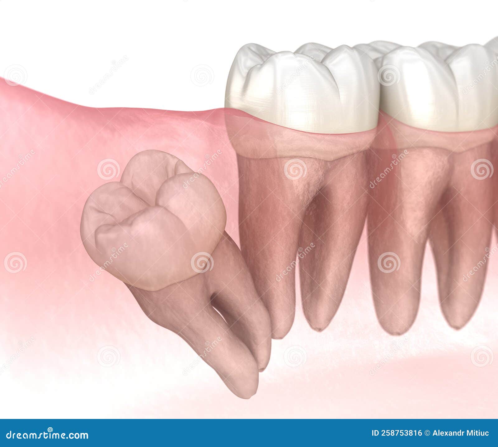 distal impaction of wisdom tooth. medically accurate tooth 3d 