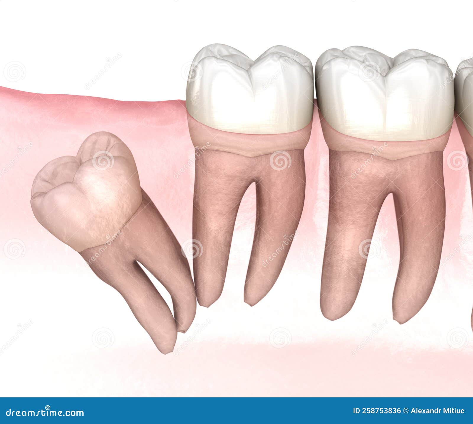 distal impaction of wisdom tooth. medically accurate tooth 3d 