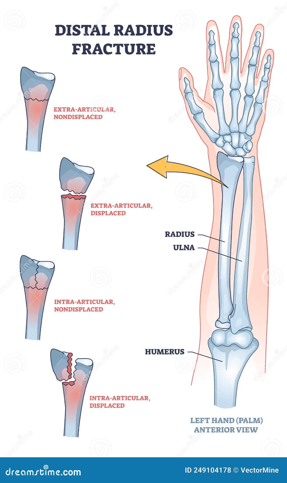 distal radius fracture and broken arm bone types anatomy outline diagram