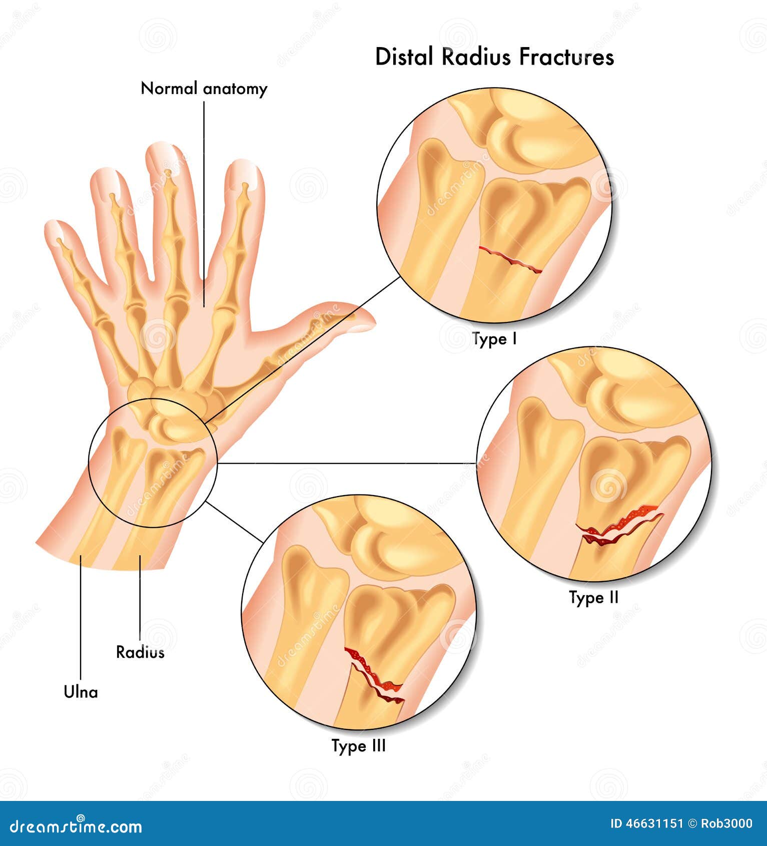 distal radius fractures