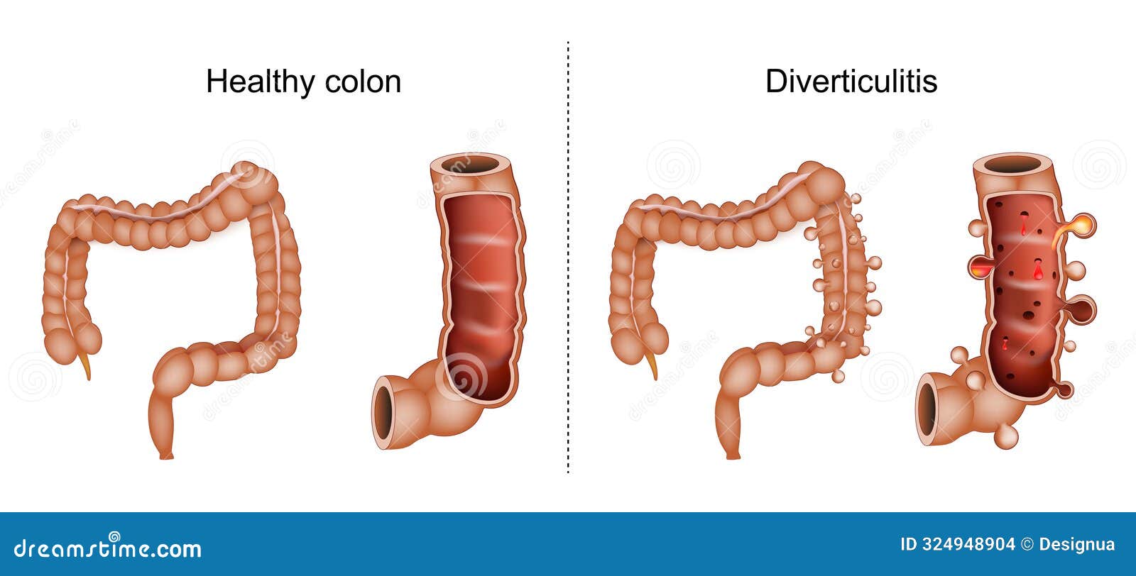 Diverticulitis. Comparison And Difference Between A Healthy Intestine