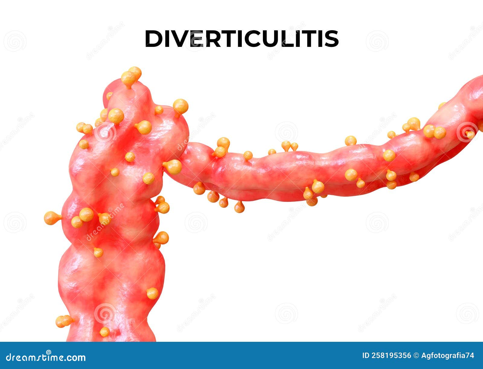 Diverticulitis And Diverticulosis Cartoon Vector CartoonDealer diverticulitis-and-diverticulosis-cartoon-vector-cartoondealer