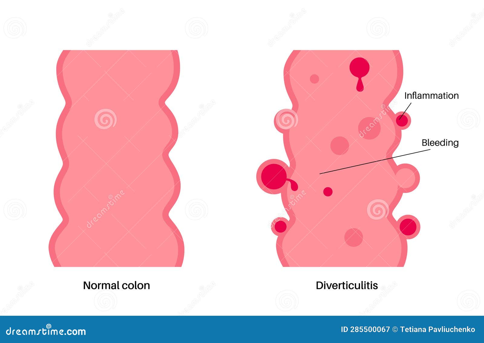 Diverticulitis And Diverticulosis Cartoon Vector CartoonDealer diverticulitis-and-diverticulosis-cartoon-vector-cartoondealer