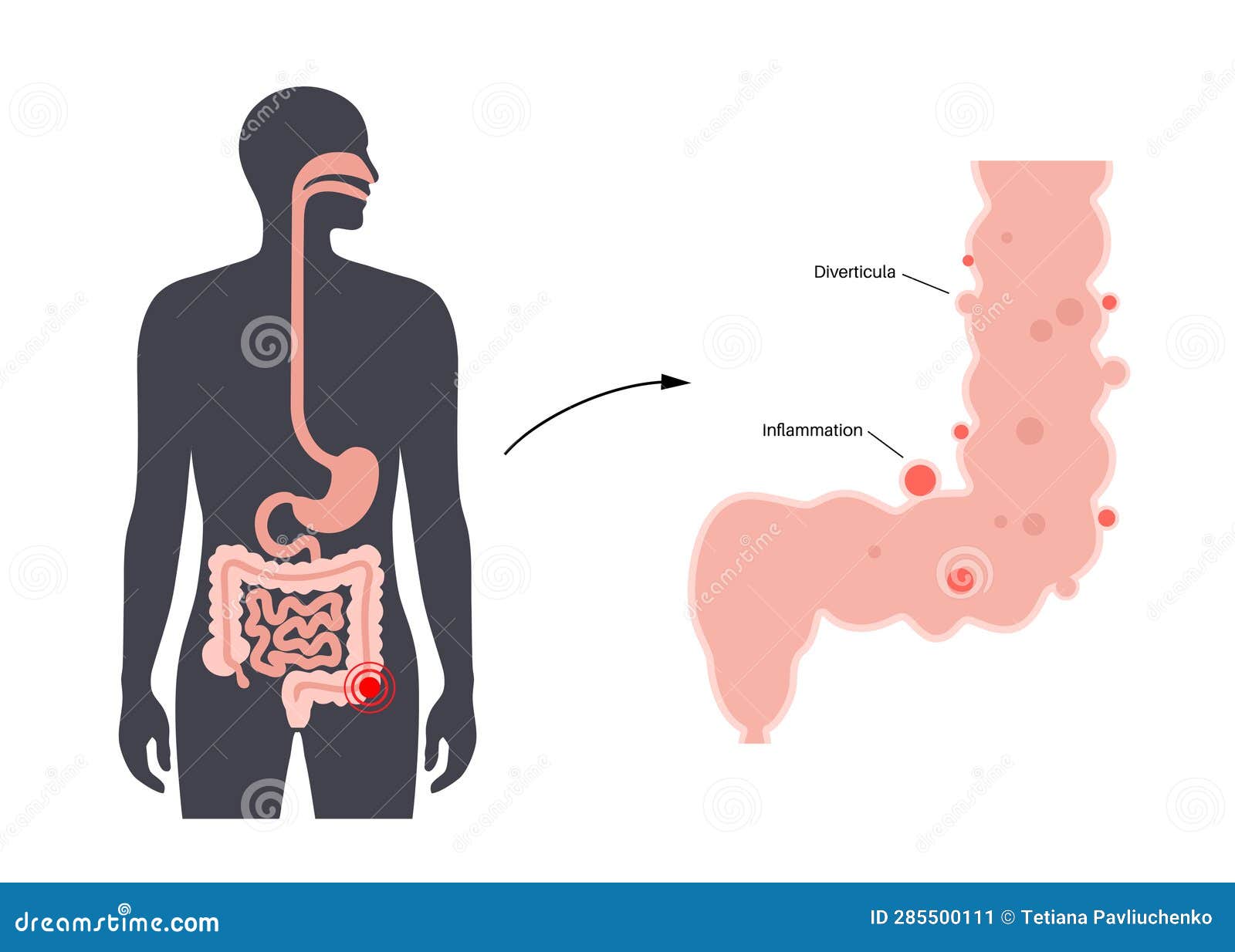 diverticulitis and diverticulosis