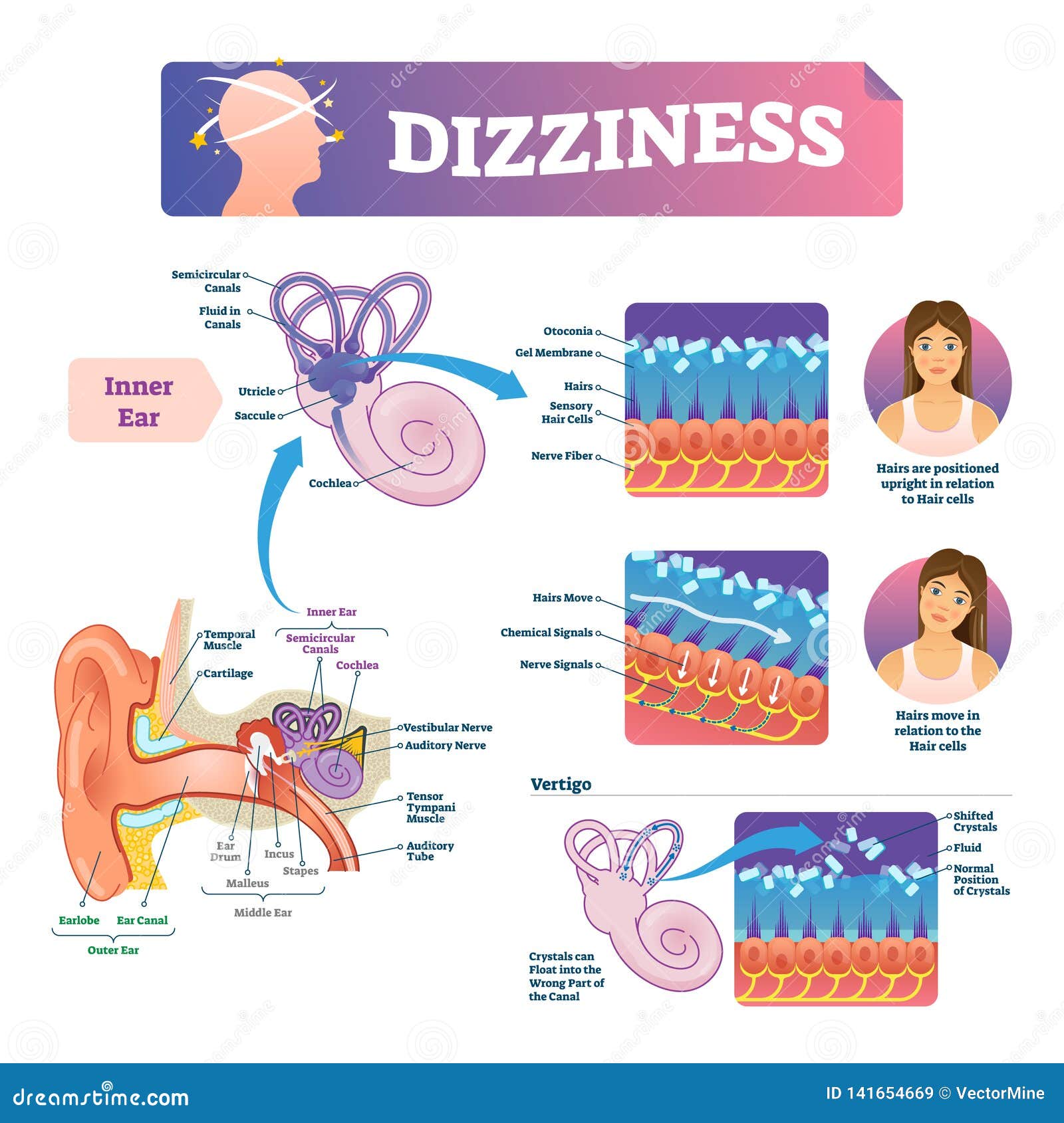 dizziness  . labeled scheme with inner ear and vertigo.