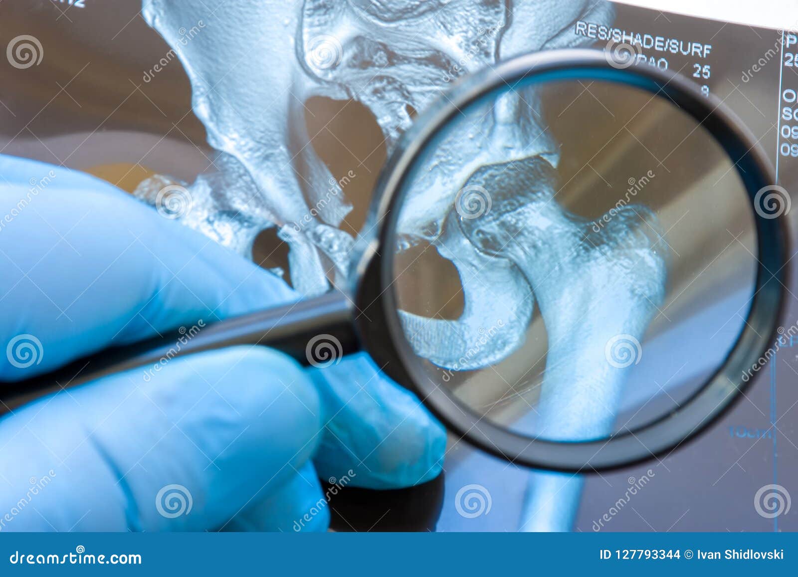 doctor examines mri snapshot of hip joint with magnifying glass. careful diagnosis rare and occurs widely hip joint diseases such