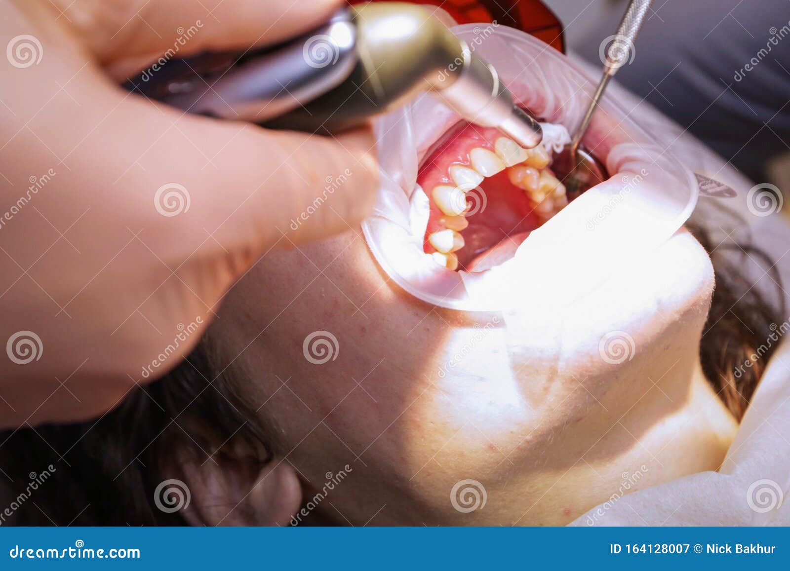 The Doctor Inserts the Patient Braces on the Teeth. the Process of the