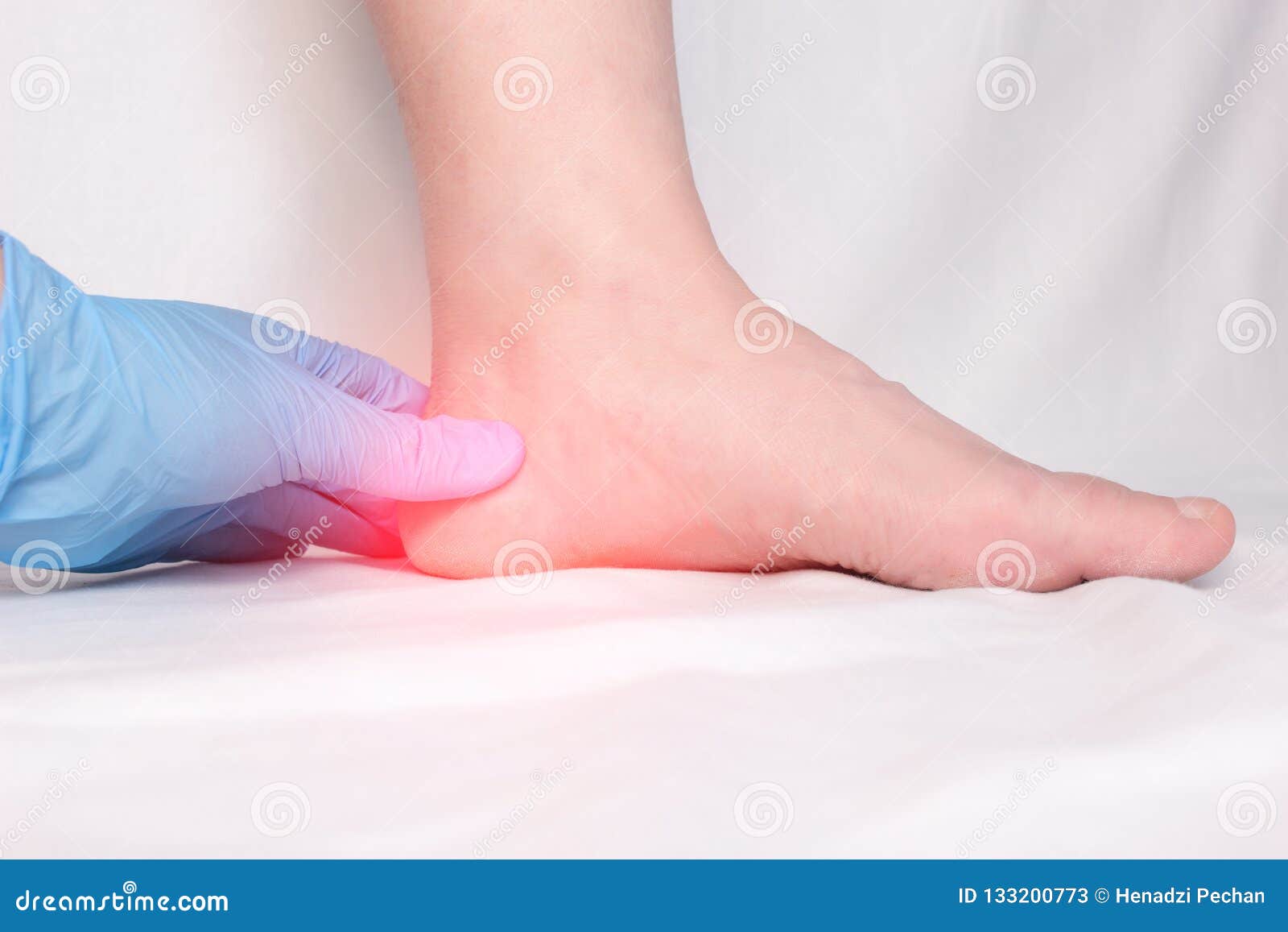 a doctor in medical gloves examines a patient`s heel spur, pain in the foot and heel, plantar fasciitis, close-up
