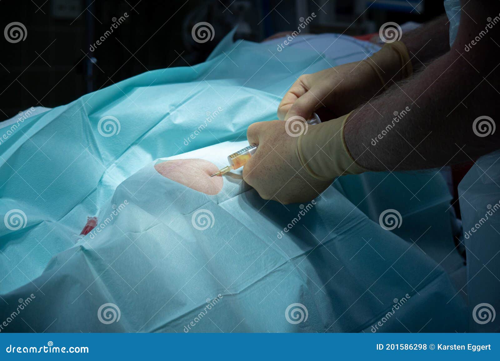 Doctor Performs a Knee Puncture in an Operating Room with a Cannula and