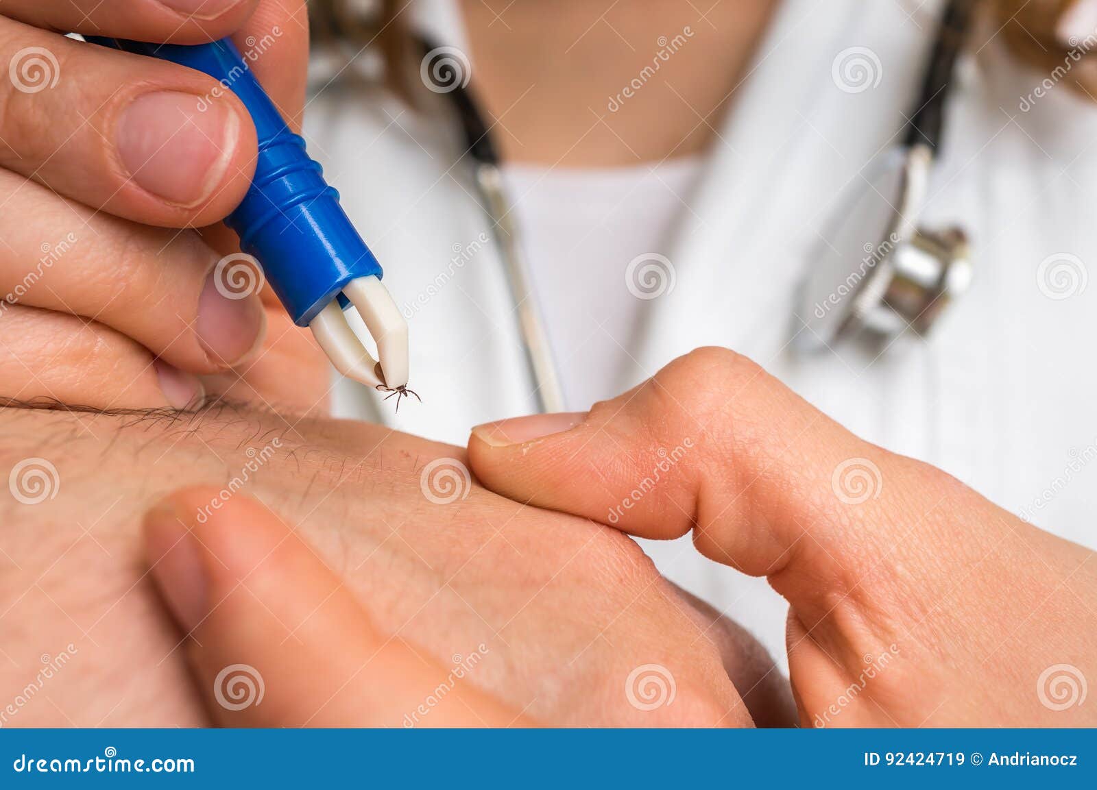 Doctor Removing A Tick With Tweezers From Hand Of Patient Stock Image